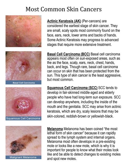 Skin Cancer Types Pics