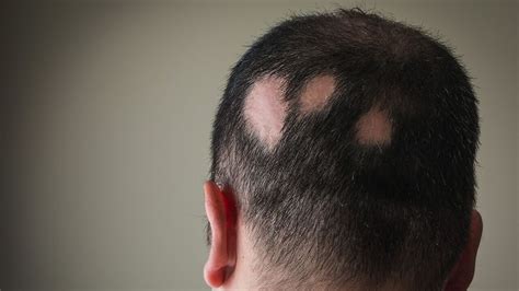 Alopecia Areata and Hair Loss: Causes, Symptoms, Treatment – The Amino ...