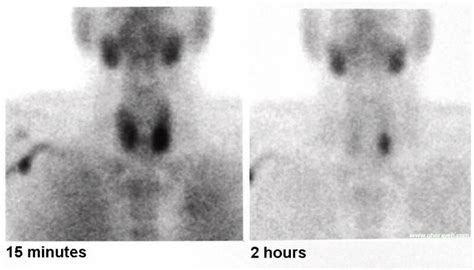 Parathyroid Adenoma - Oncology - Medbullets Step 1