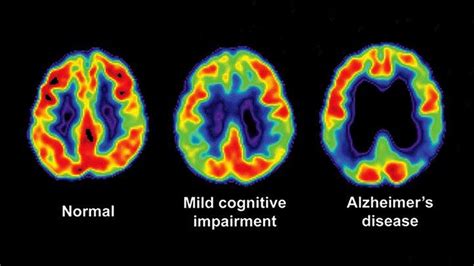 La TEP amyloïde pourrait changer radicalement le diagnostic et les ...