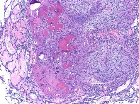 Adenomatoid odontogenic tumor histology demonstrating duct-like ...