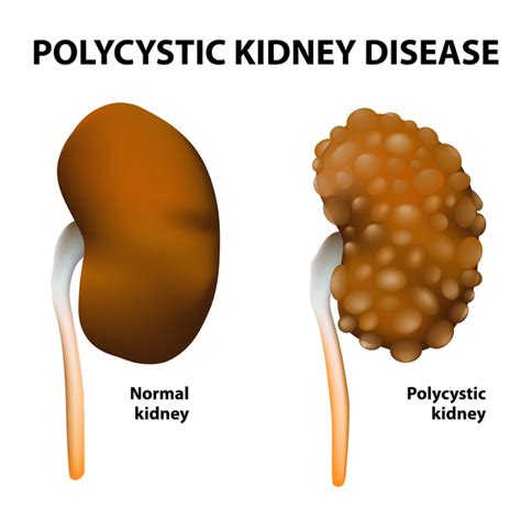 Polycystic kidney disease: MedlinePlus Genetics