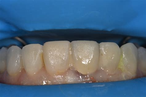 Smile Design using Porcelain Veneers and Crown