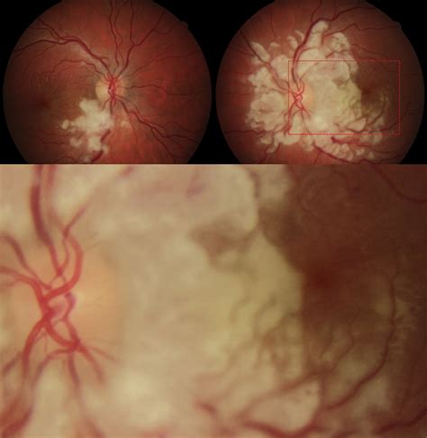 Purtscher's Retinopathy - Ophthalmology