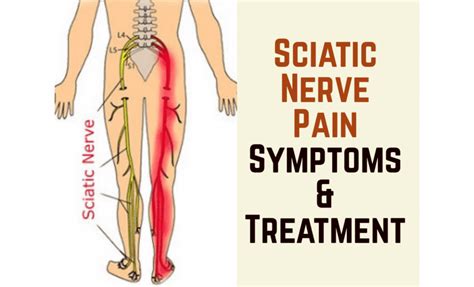 Tens Unit Placement Sciatica Pain