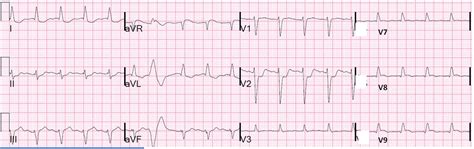 Dr. Smith's ECG Blog: 2014