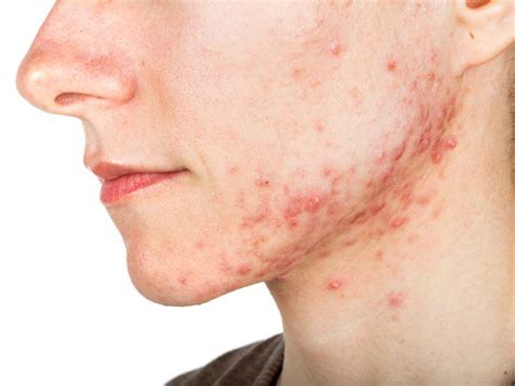 A new vaccine could wipe out acne