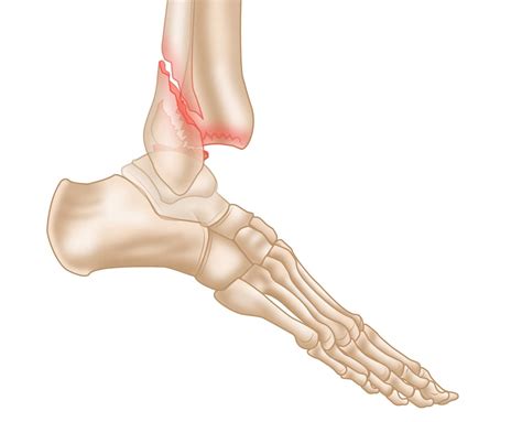 Displaced Trimalleolar Ankle Fracture