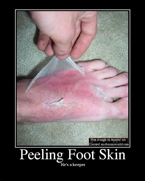 Peeling Foot Skin - Picture | eBaum's World