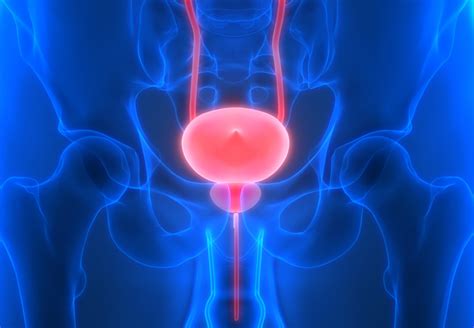 Bladder Neck Contracture (BNC) | Female and Reconstructive Urologist ...