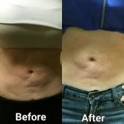 Ultrasonic Cavitation Tampa| Bellissimo You