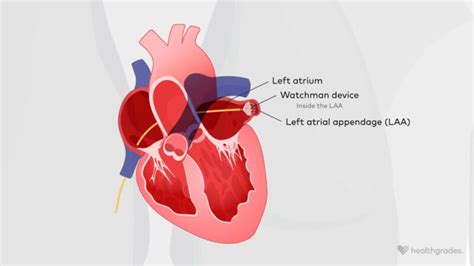 Watchman Procedure: Why It’s Done, Risks, and What to Expect