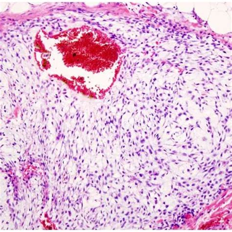 Chondrosarcoma - Symptoms, Types, Causes & Diagnosis