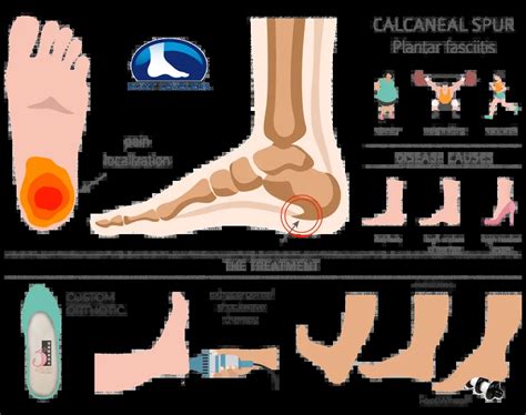 Plantar fasciitis - ShawneeLyanna