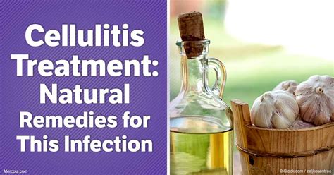 Try These Natural Alternatives for Cellulitis Treatment