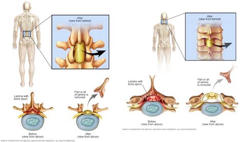 Best Laminectomy Surgery Cost In India 2021 - Medicare Spots