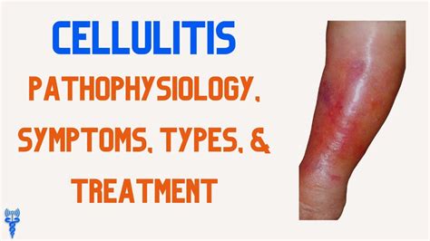 Cellulitis Symptoms Causes Pictures And Treatment