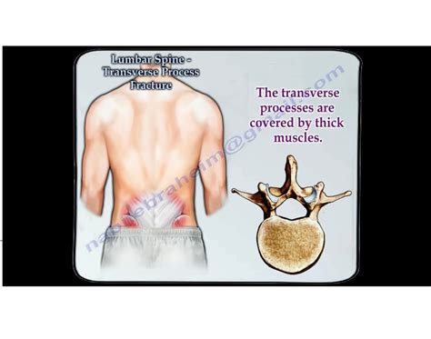 Lumbar Spine Transverse Process Fracture — OrthopaedicPrinciples.com