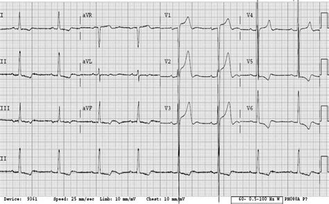 Left Ventricular Hypertrophy (LVH) • LITFL • ECG Library Diagnosis