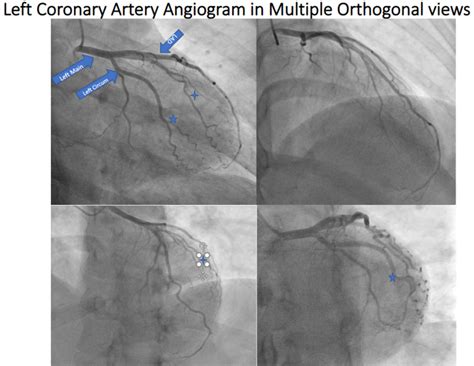 Left Coronary Artery Angiogram