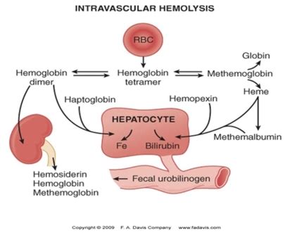 Intravascular destruction of RBCs.74 Intravascular hemolysis usually ...