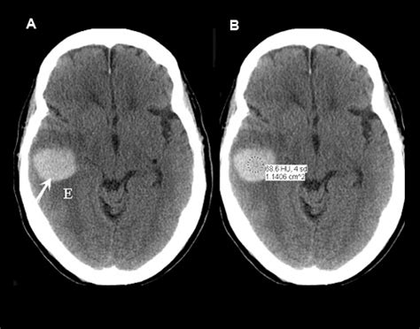 intracranial Hemorrhage