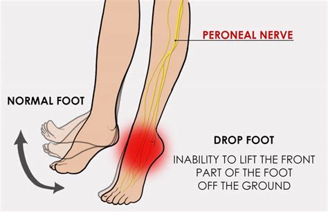 Would ALS or MS Foot Drop Make Driving Difficult? » Scary Symptoms