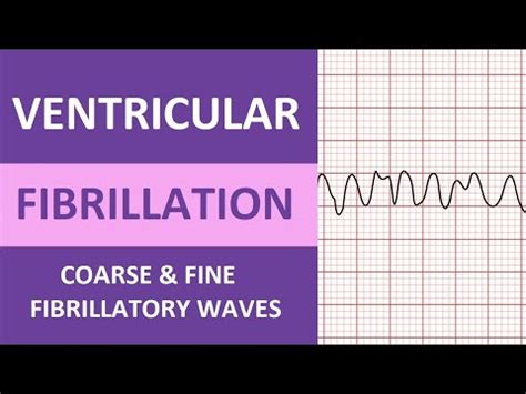 Ventricular Fibrillation (V-fib) ECG/EKG Nursing Review