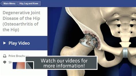 severe degenerative joint disease Hip joint disease degenerative ...