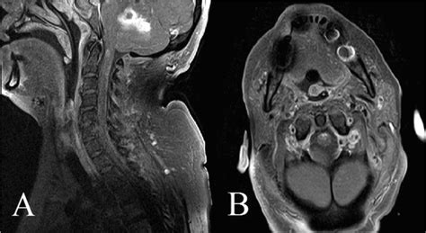 Abnormal Cervical Spine Mri