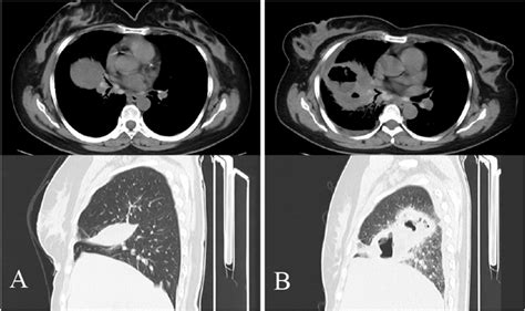 CT showed oblique fissure effusion of right lung on Oct. 8 (a) and ...