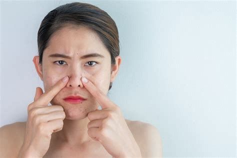 Understanding Blackheads: Causes and Prevention