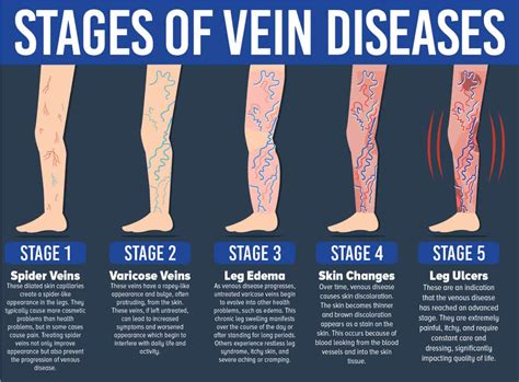 Venous Ulcers - Ivein Clinic