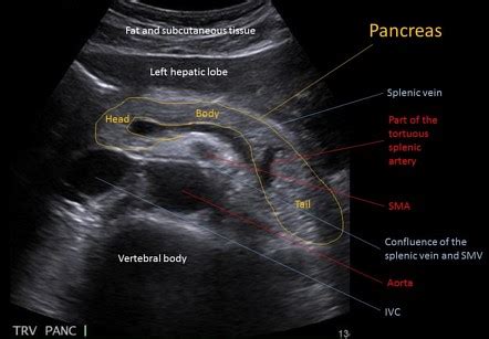 Image | Radiopaedia.org