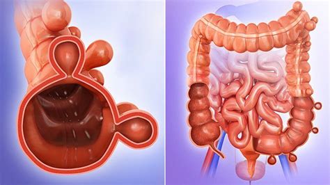 block Siege cache diverticulosis in the sigmoid colon mature Prick Outflow