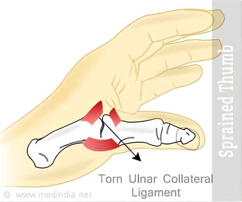 Sprained Thumb - Causes, Symptoms, Diagnosis, Treatment