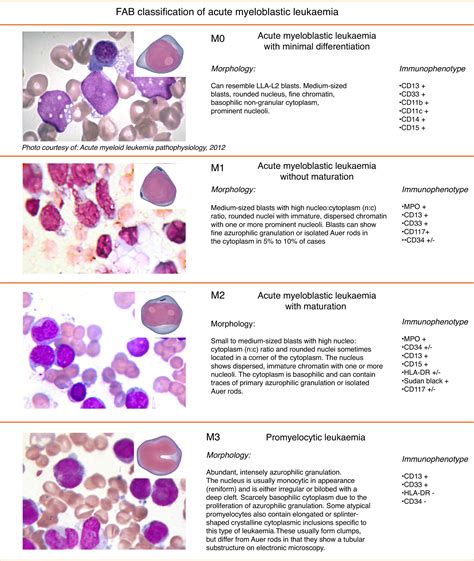 Morphology of leukaemias | Revista Médica del Hospital General de ...