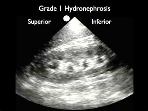 Mild Hydronephrosis Ultrasound