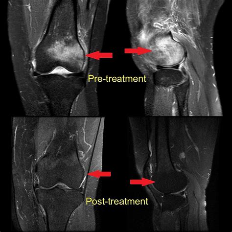 Effectiveness of Iloprost in the Treatment of Bone Marrow Edema | Cureus