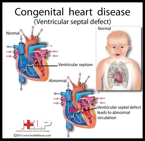 Congenital Heart Defects Diagram