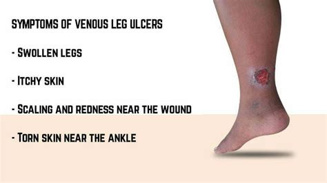 Venous Leg Ulcer: Symptoms, Causes, and Prevention