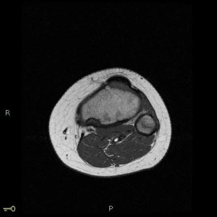 Fibrous cortical defect | Image | Radiopaedia.org