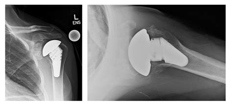 Shoulder Replacement | Shoulder Arthritis | Colorado