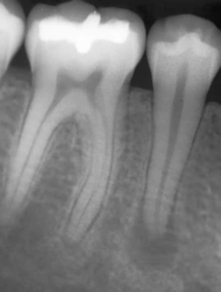 Acute Apical Periodontitis