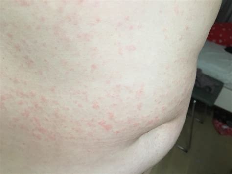 I definitely have scabies. But have developed a new rash and don’t know ...