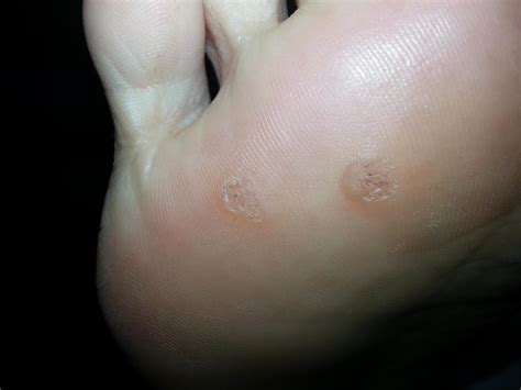 Plantar Wart treatments | Laser Wart Treatment | Most effective