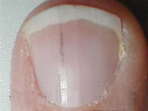 Splinter Fingernails - Curious symptom caused by a blow or possibly an ...