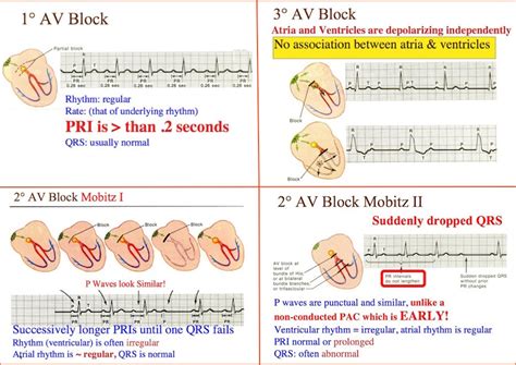 Atrioventricular block (AV block) is a type of heart block in which the ...