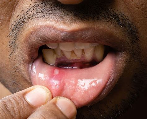 Understanding The Different Types Of Mouth Ulcers - Ask The Nurse Expert