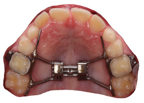 Rapid Palatal Expander (Palate Expander) - Yang Orthodontics